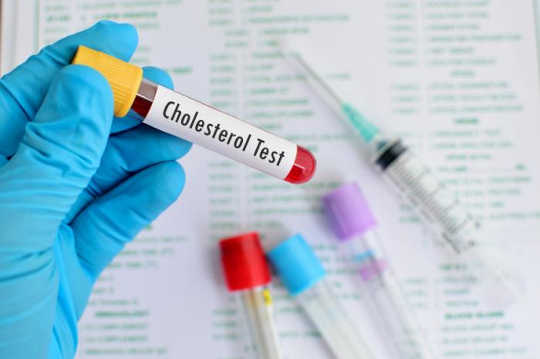 The Simple Cholesterol Test That Says If You Really Need Statinsx